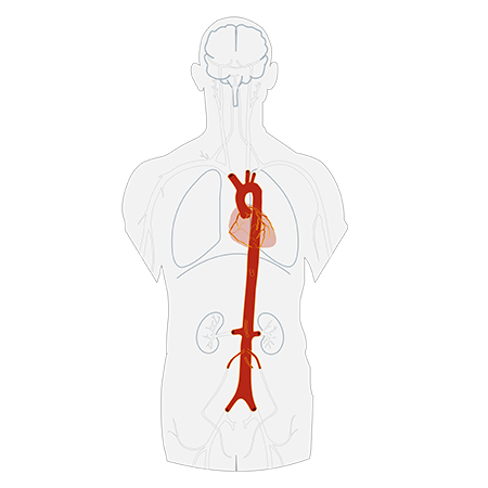 Aortic Surgery