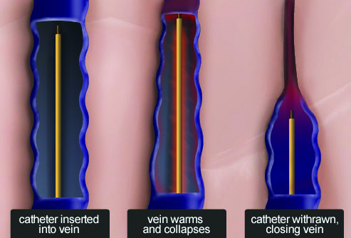 Catheter in Vein