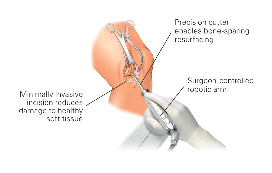 Partial knee replacement mako