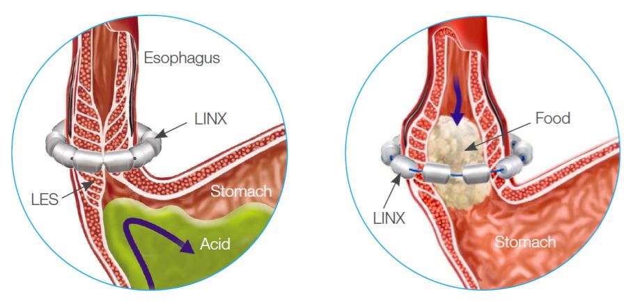 Linx Acid Reflux