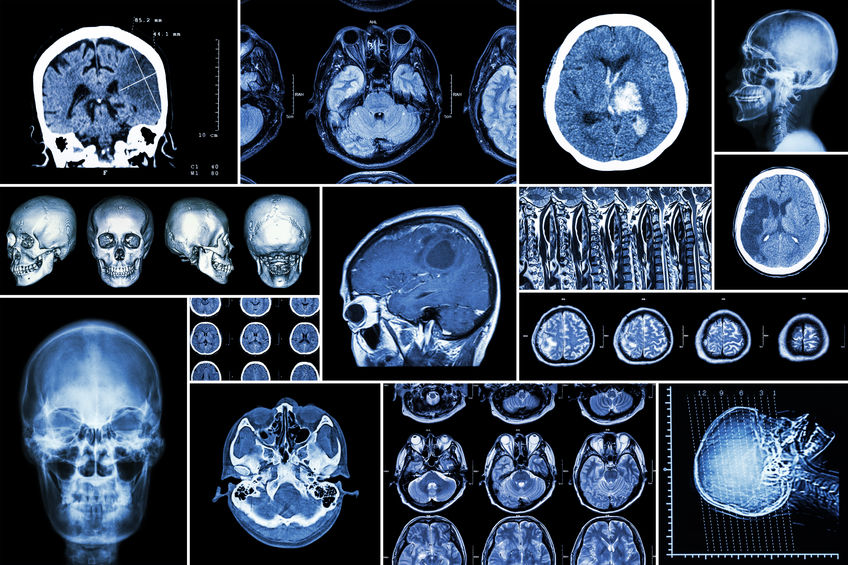 diseased brain scans