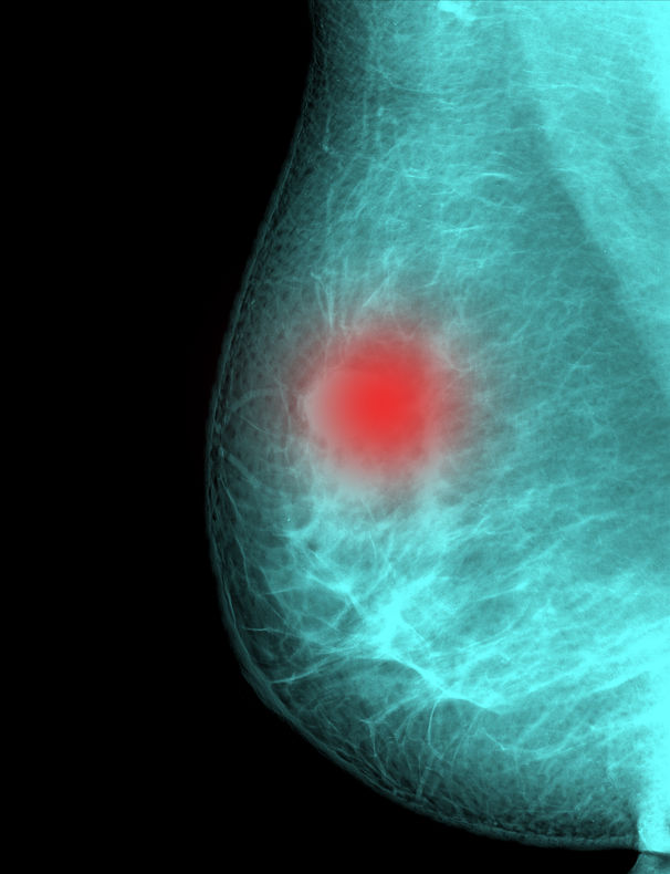 X-ray mammogram image of breast with cancer