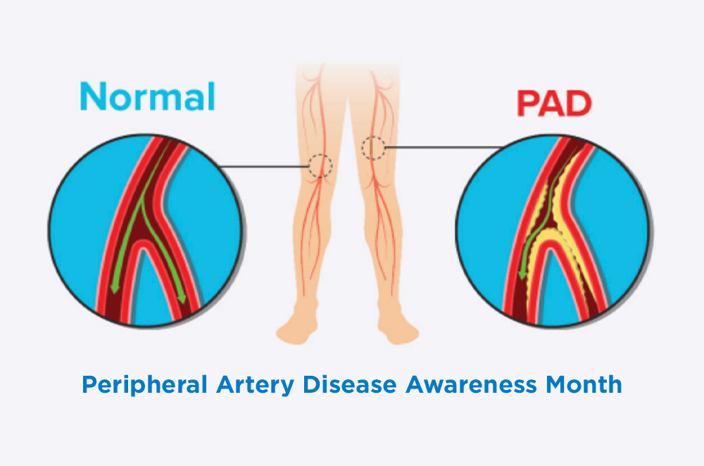 September is Peripheral Artery Disease Awareness Month