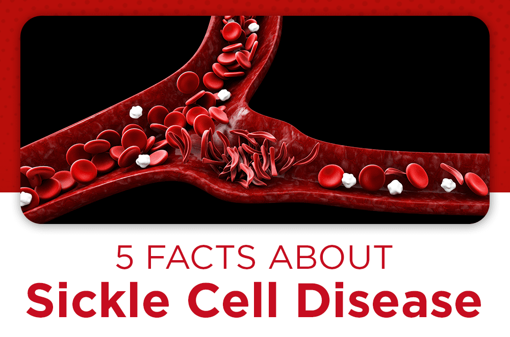 5 Facts about Sickle Cell Disease